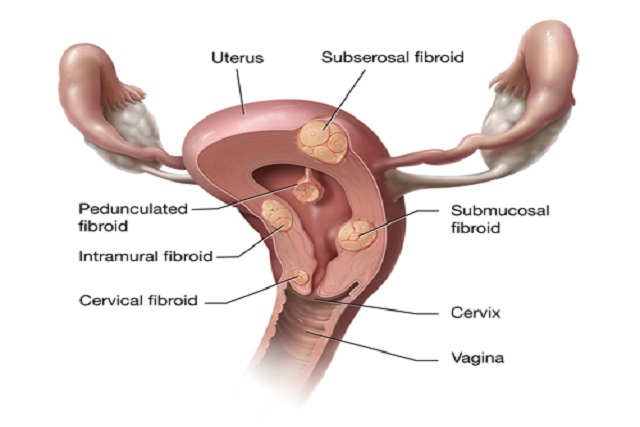 Cervical fibroids